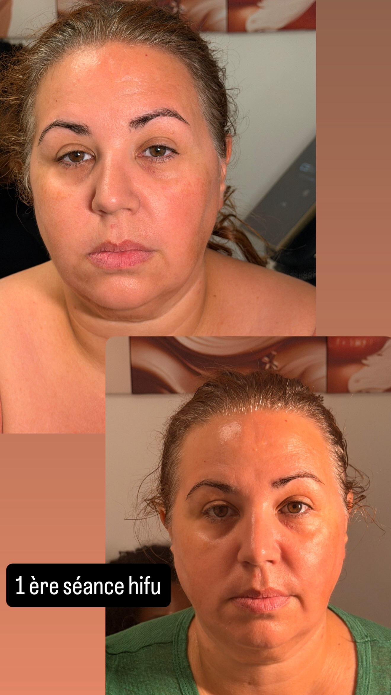 Résultats Avant Après HIFU double menton et ovale femme - Dikki Beauté