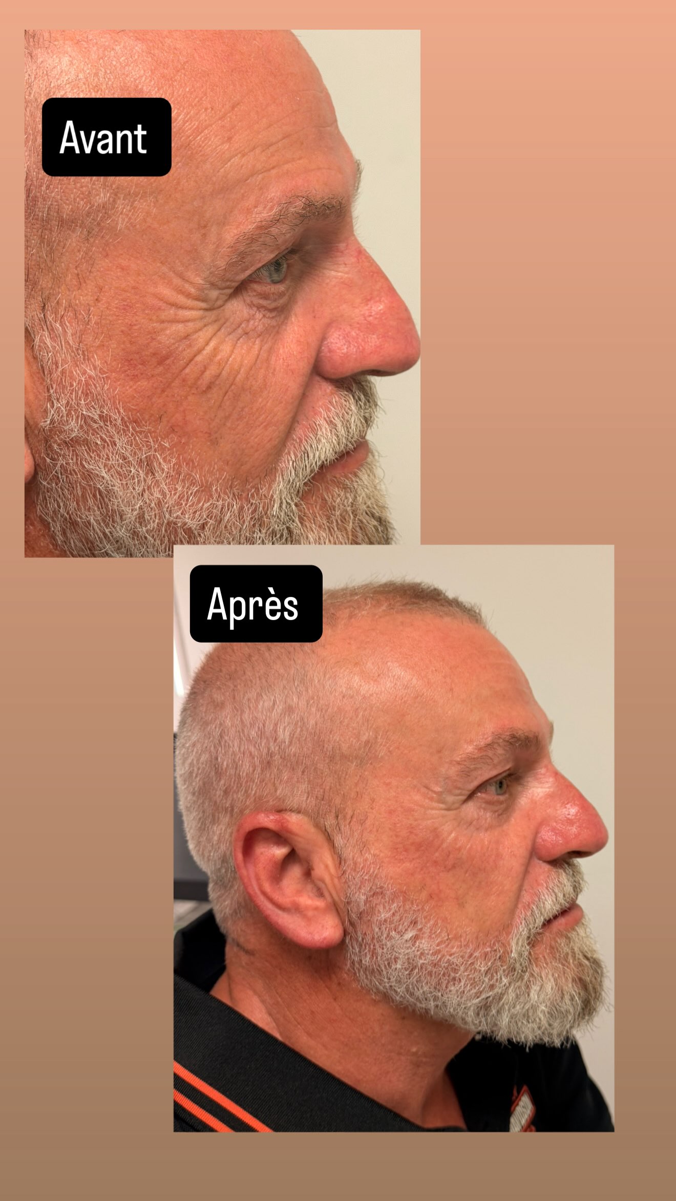 Résultats Avant Après HIFU homme profil rides patte d oie - Dikki Beauté