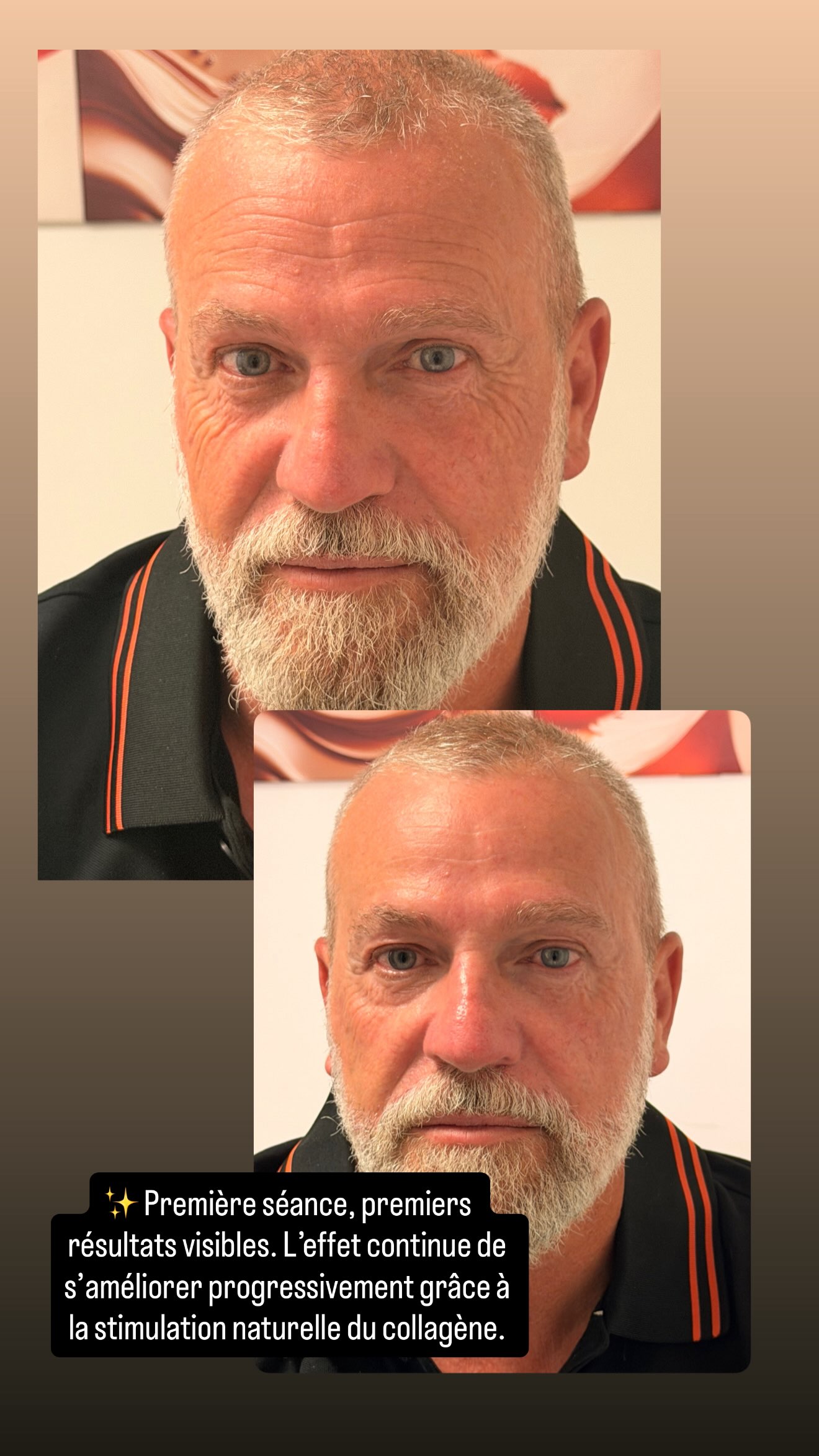 Résultats Avant Après HIFU homme visage entier stimulation collagène - Dikki Beauté
